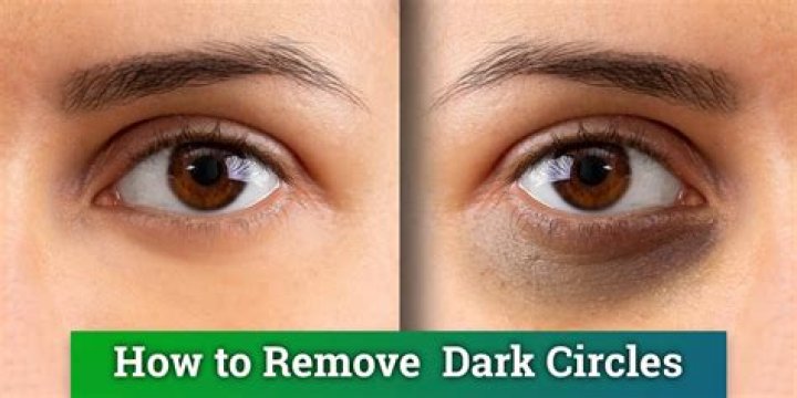 Do dark circles go away?