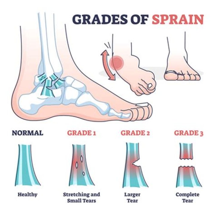 Do Grade 2 sprains require surgery?