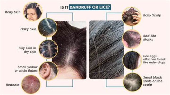 Do lice like dandruff?
