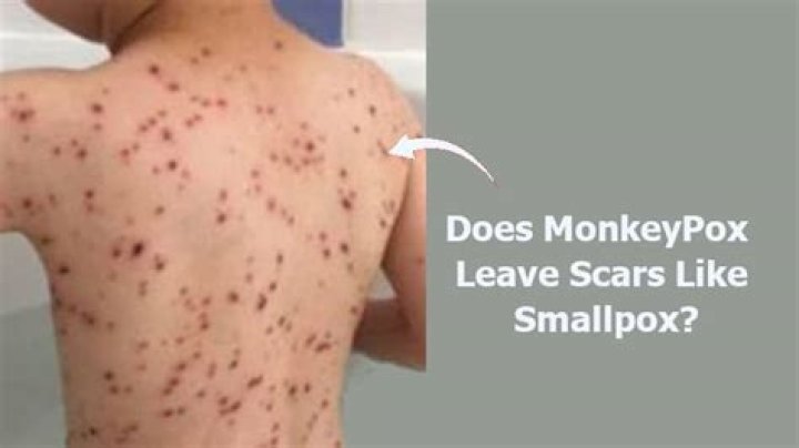 Do monkeypox leave scars?