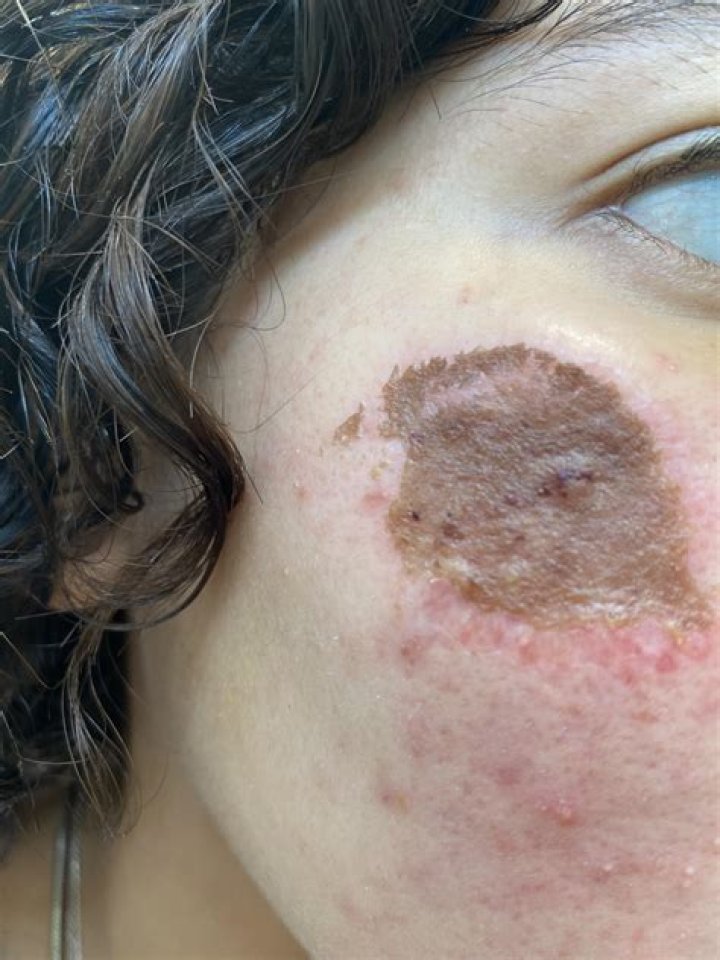 Do skin grafts scab over?