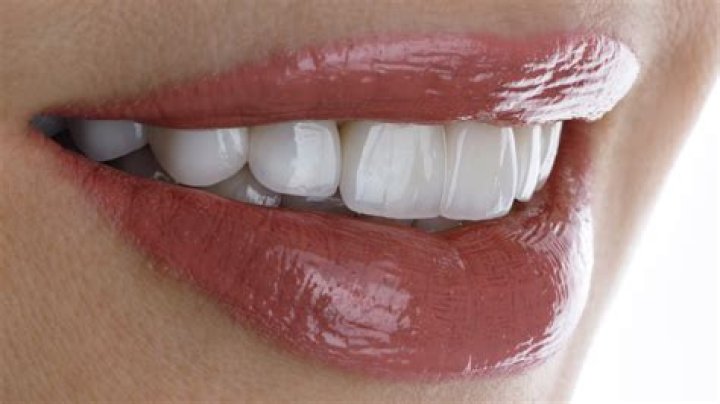 Do veneers go yellow?