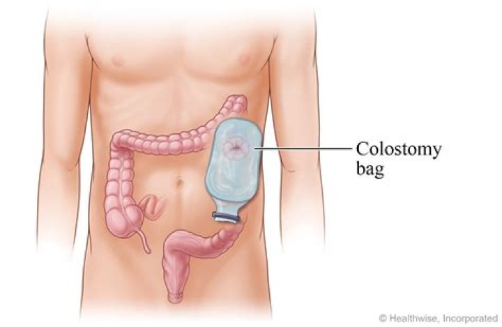 Do you need a colostomy bag with diverticulitis?