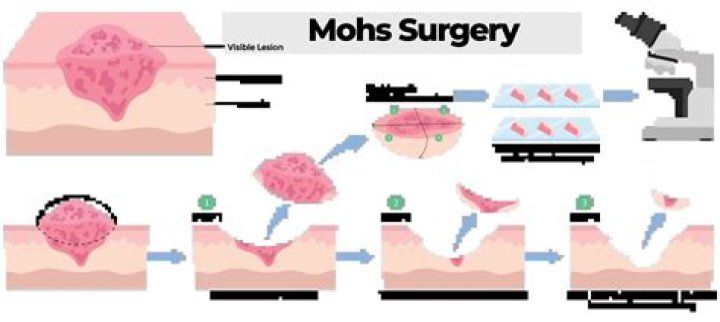 Do you need to rest after Mohs surgery?
