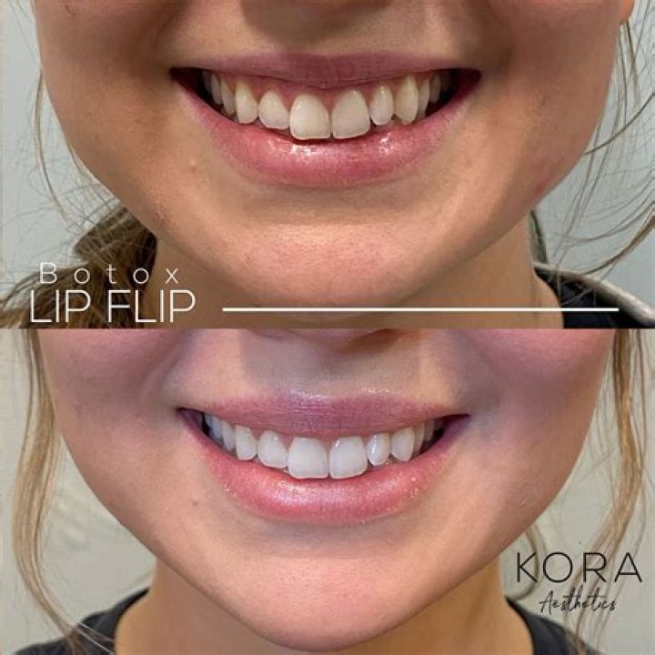 Does a lip flip show more teeth?