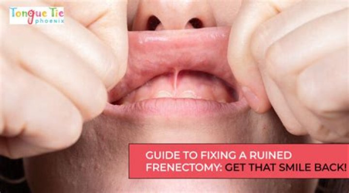 Does frenectomy affect smile?