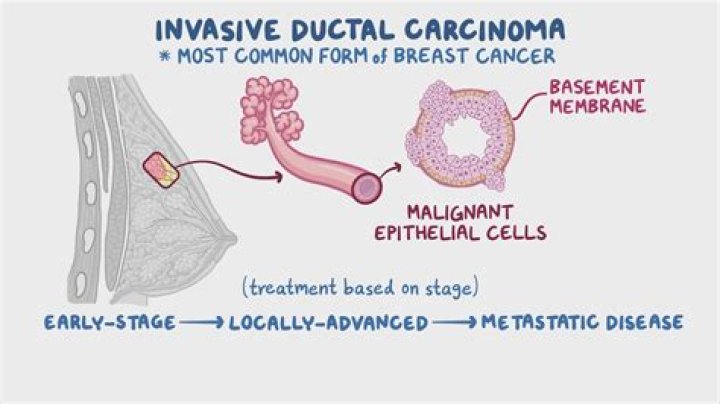 Does invasive ductal carcinoma return?