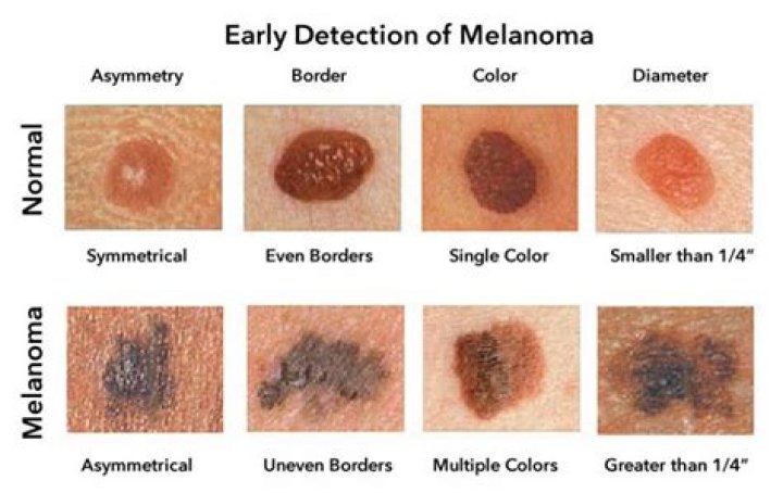 Does melanoma itch or hurt?
