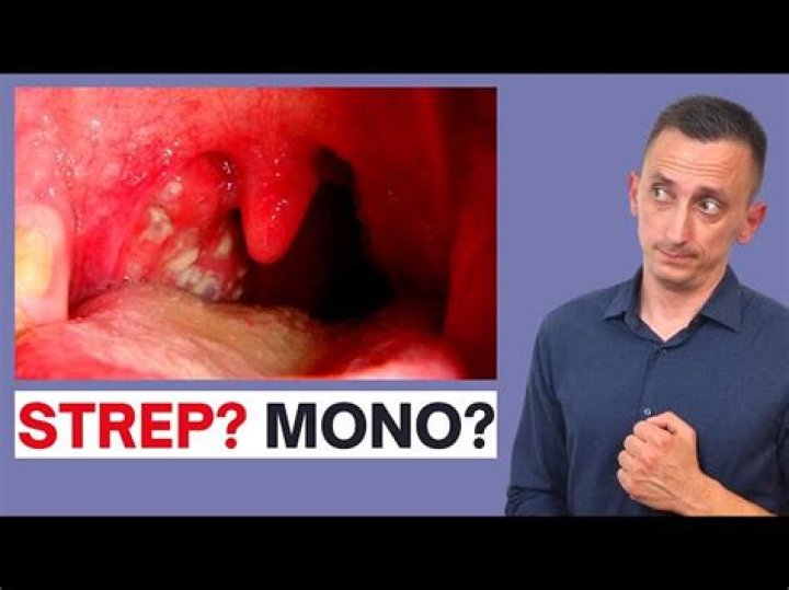 Does mono look like strep?