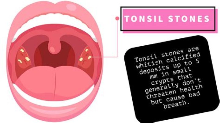 Does mouthwash help tonsil stones?