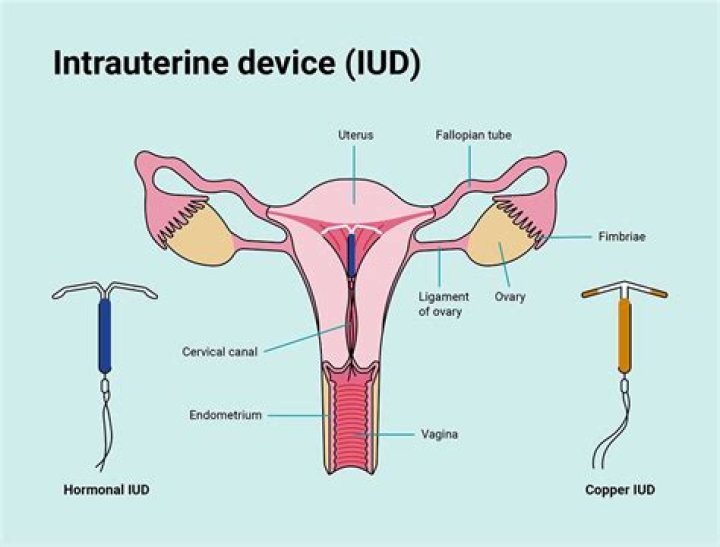 Does placement of IUD hurt?