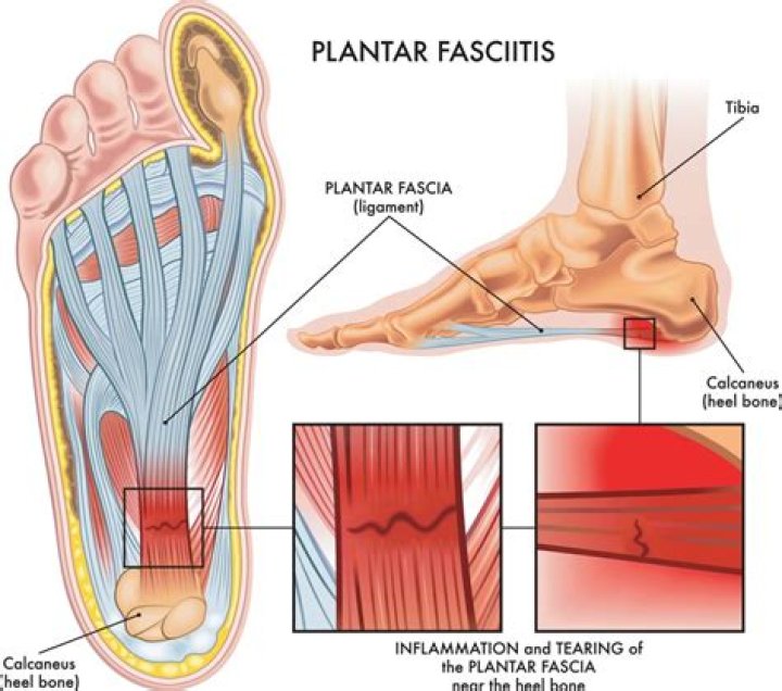 Does plantar fasciitis throb at night?