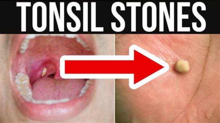 Does removing tonsils make you gain weight?