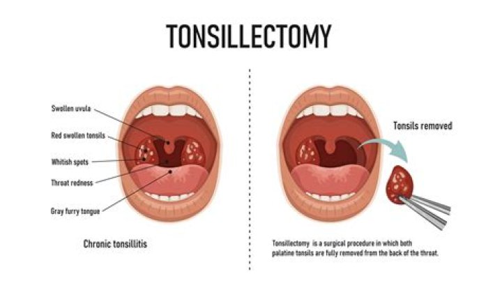 Does removing tonsils shorten your life?