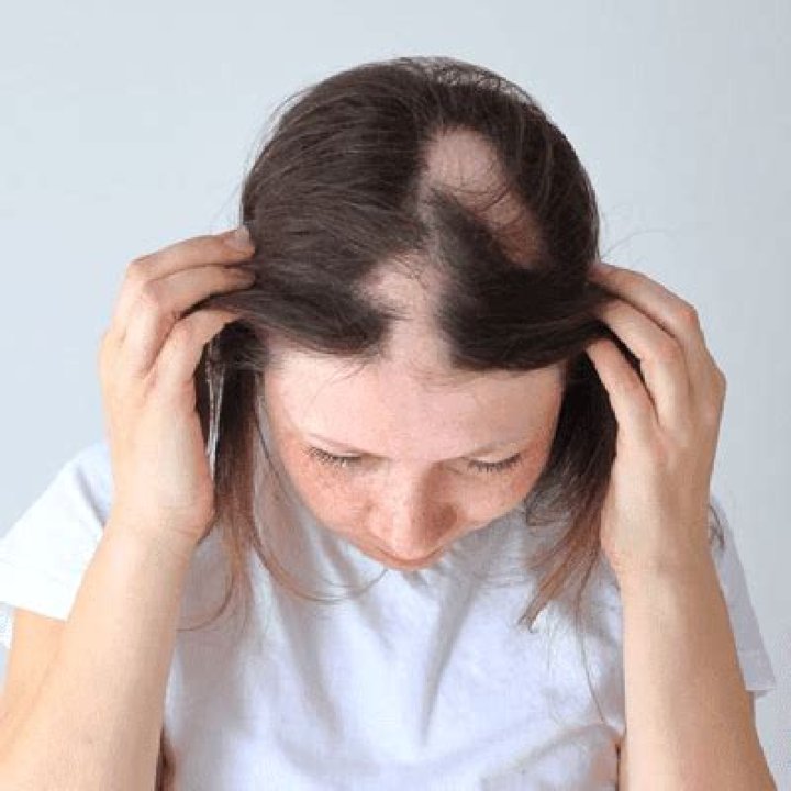 Does Saxenda cause hair loss?