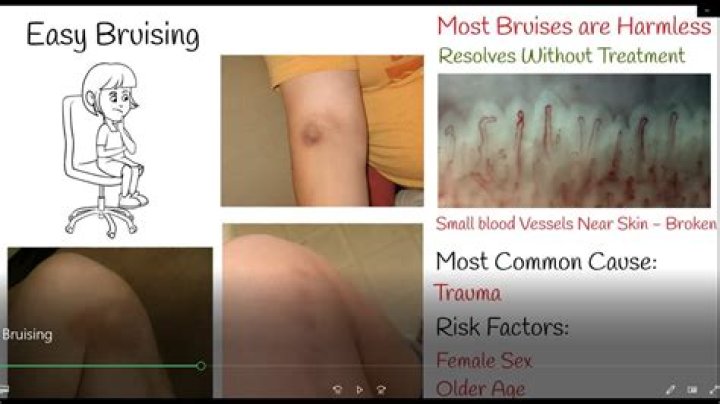 Does TB cause bruising?