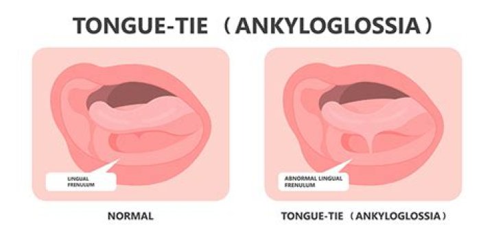 Does tongue-tie go away?