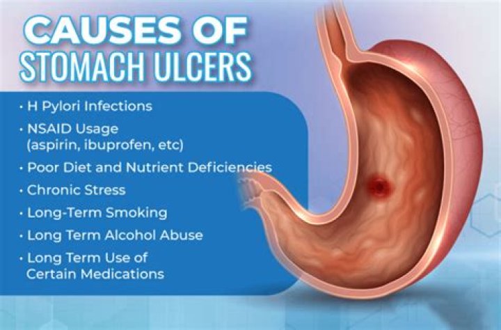 Does ulcer cause chest and back pain?
