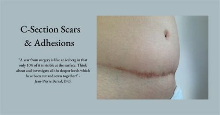 Does your C-section scar hurt when you get pregnant again?
