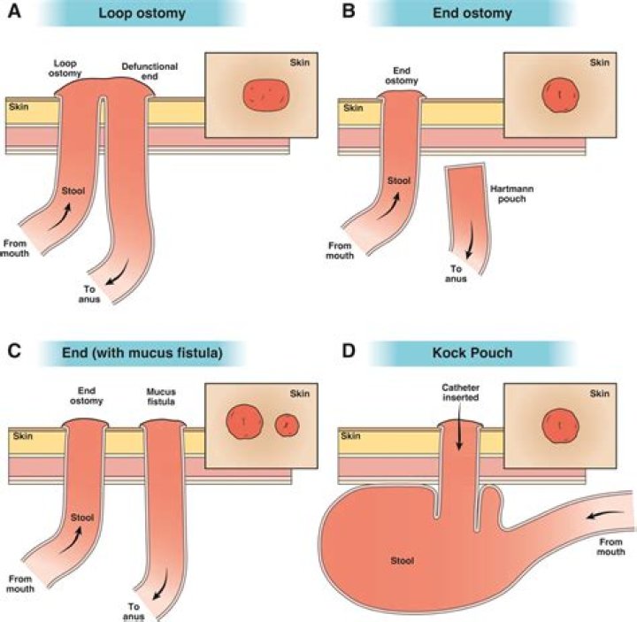 How big is a colostomy hole?