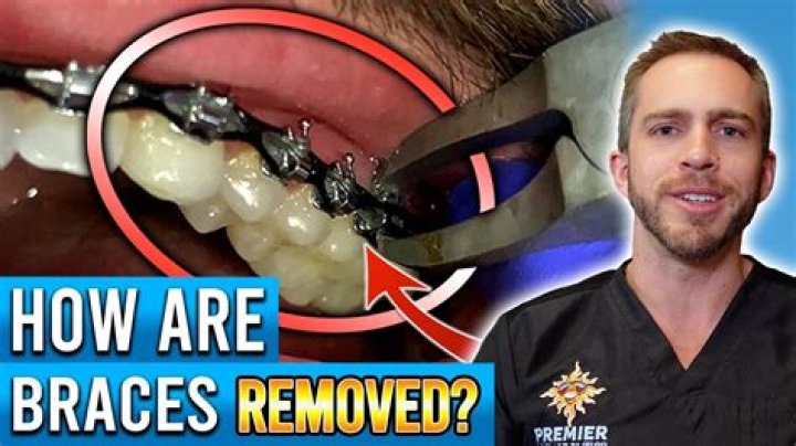 How braces are removed from teeth?