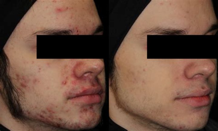 How can a 14 year old get rid of acne?
