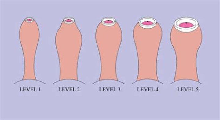 How can I heal my foreskin faster?