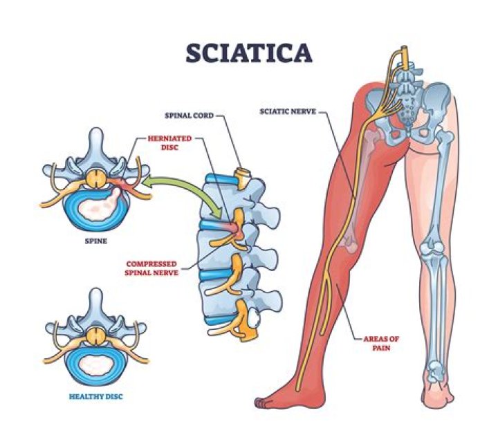 How can I permanently fix sciatica?
