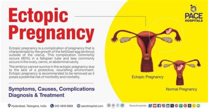 How can I reduce the risk of ectopic pregnancy?