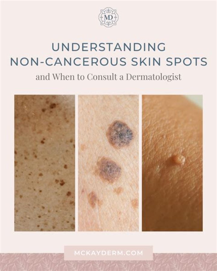 How can you tell if age spots are cancerous?