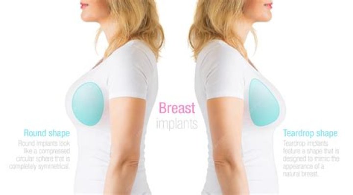 How common are issues with breast implants?