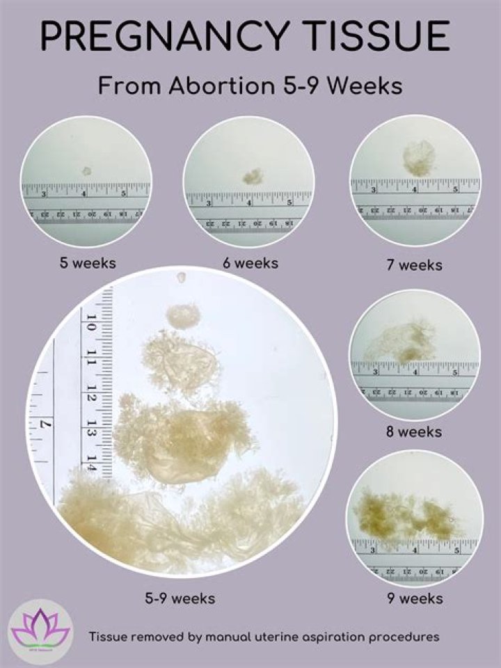 How common is miscarriage at 7 weeks?