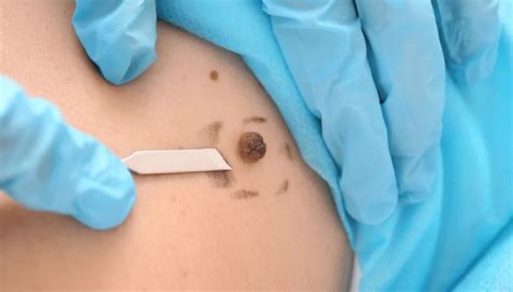How do doctors remove melanoma?