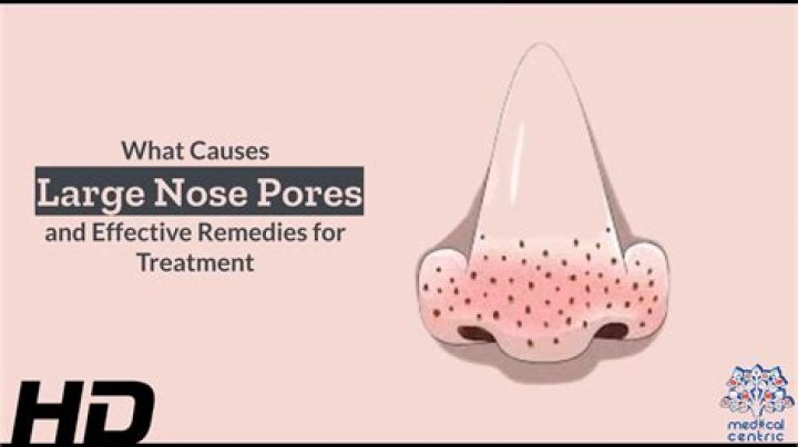How do I get rid of large pores on my nose?