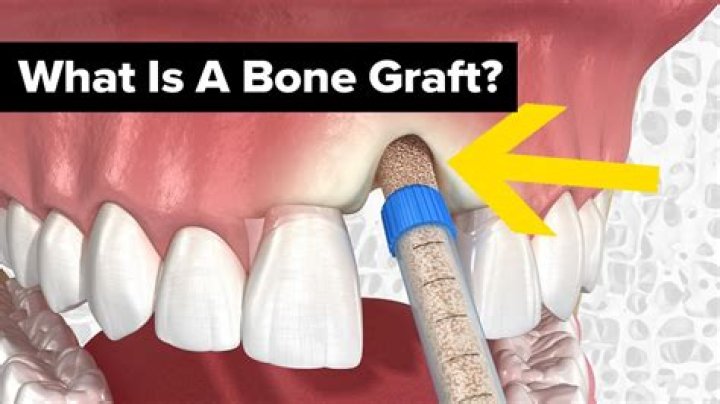 How do I know if my bone graft is infected?