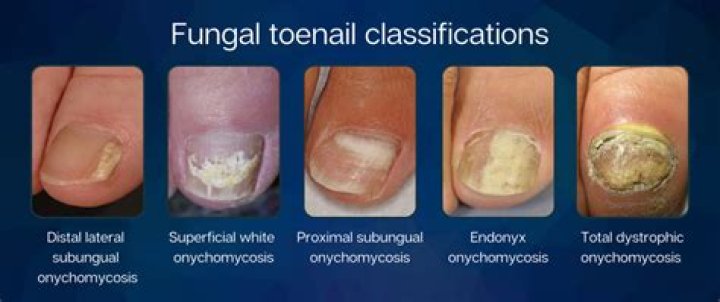 How do I know if my toenail has fungus?