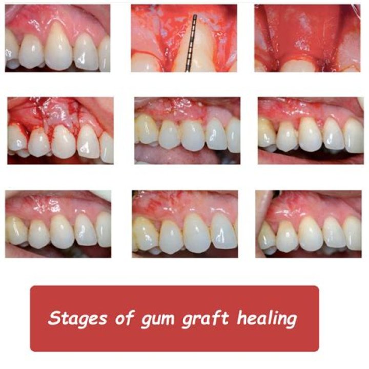 How do I know my gum graft is healing?