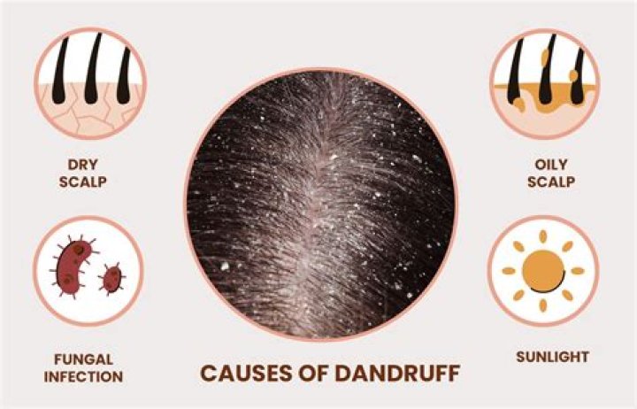 How do I stop dandruff?