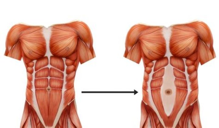 How do you fix separated stomach muscles?