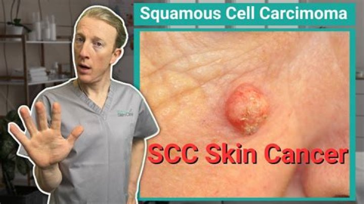 How do you get a squamous cell carcinoma?