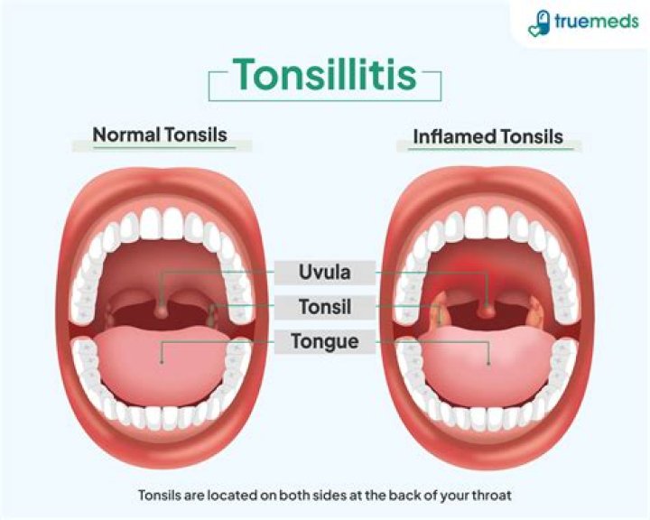 How do you get rid of swollen tonsils from mono?