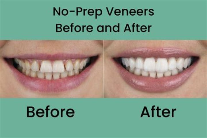 How do you keep temporary veneers white?