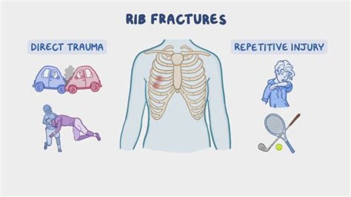 How do you know if a rib injury is serious?