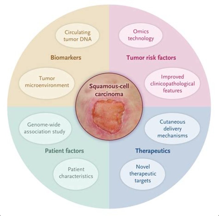 How do you know if squamous cell has spread?