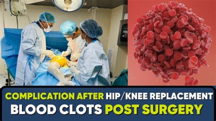 How do you know if you have a blood clot after surgery?