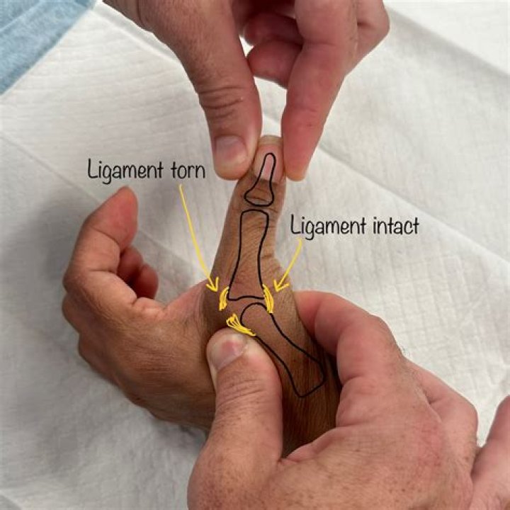 How do you know if you tore a ligament in your toe?