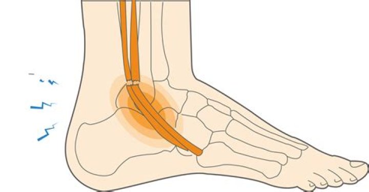 How do you know if you tore a tendon in your ankle?