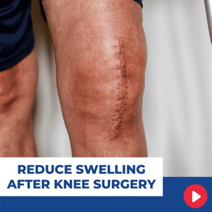 How do you reduce swelling after hip surgery?