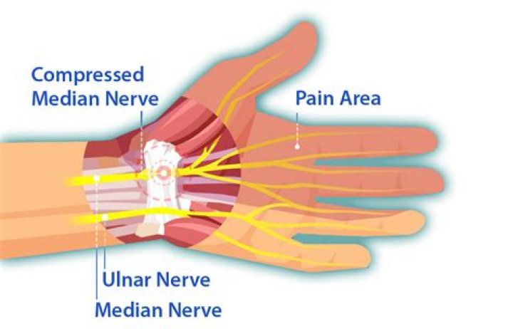 How do you treat nerve pain in your wrist?