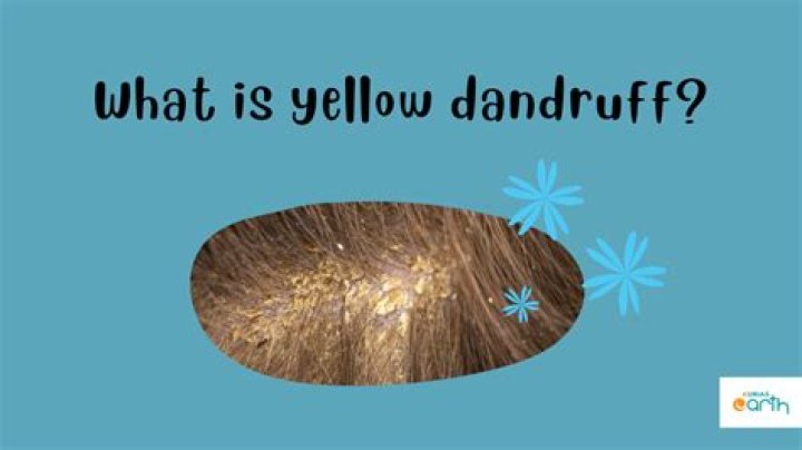 How do you treat yellow dandruff?